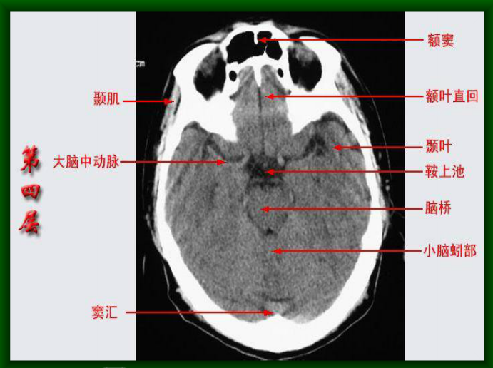 头颅ct断层解剖图片