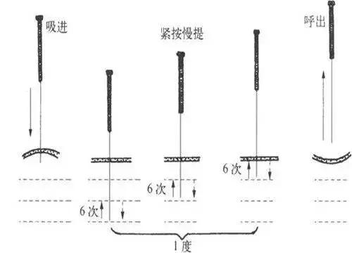 球后针刺手法示意图图片