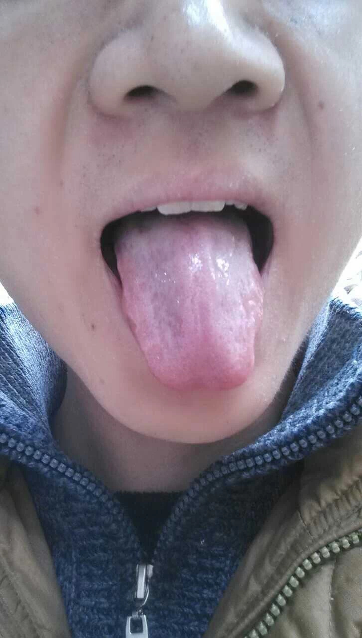 中老年人慢性萎缩性胃炎:中焦凹:能量不足.