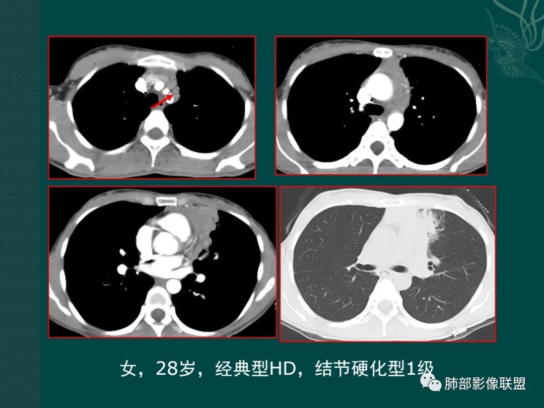 【黃勇專題講座】胸腺淋巴瘤的影像診斷