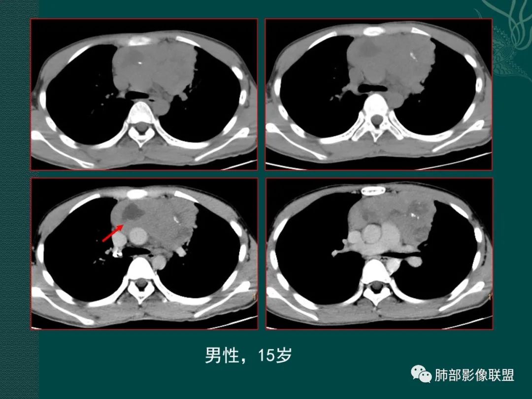 【黃勇專題講座】胸腺淋巴瘤的影像診斷