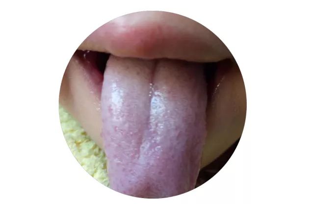【四诊】看孩子舌苔,掌握这几个关键点!