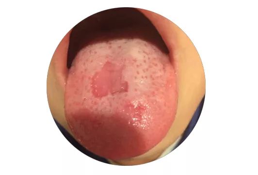 所以,舌苔的剥落是脾胃精气受损,水谷精气无法升腾到舌面的一种象征