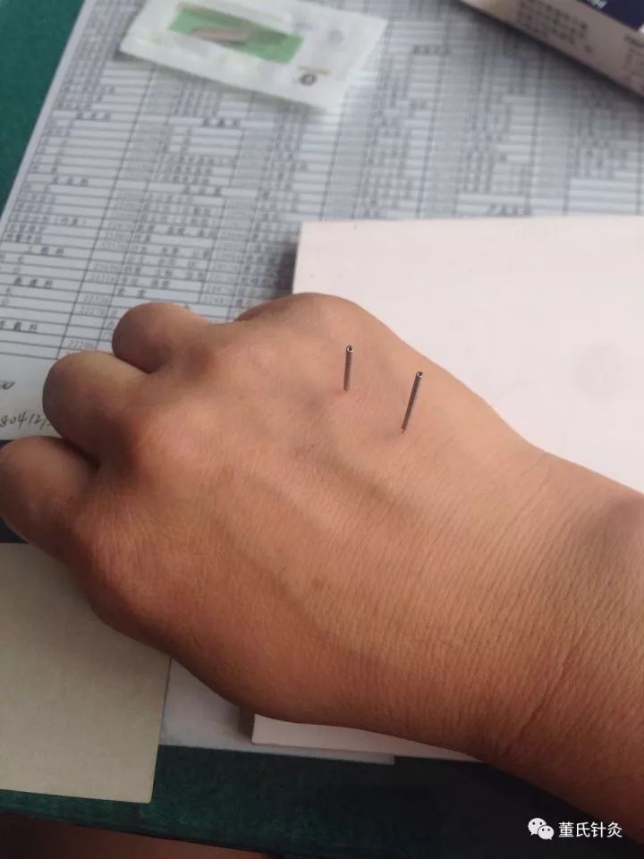 董氏针灸眼科病症