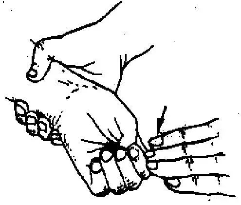 又称芬克斯坦(finkeisten)征.患者拇指屈曲握拳,将拇指握于掌心内.