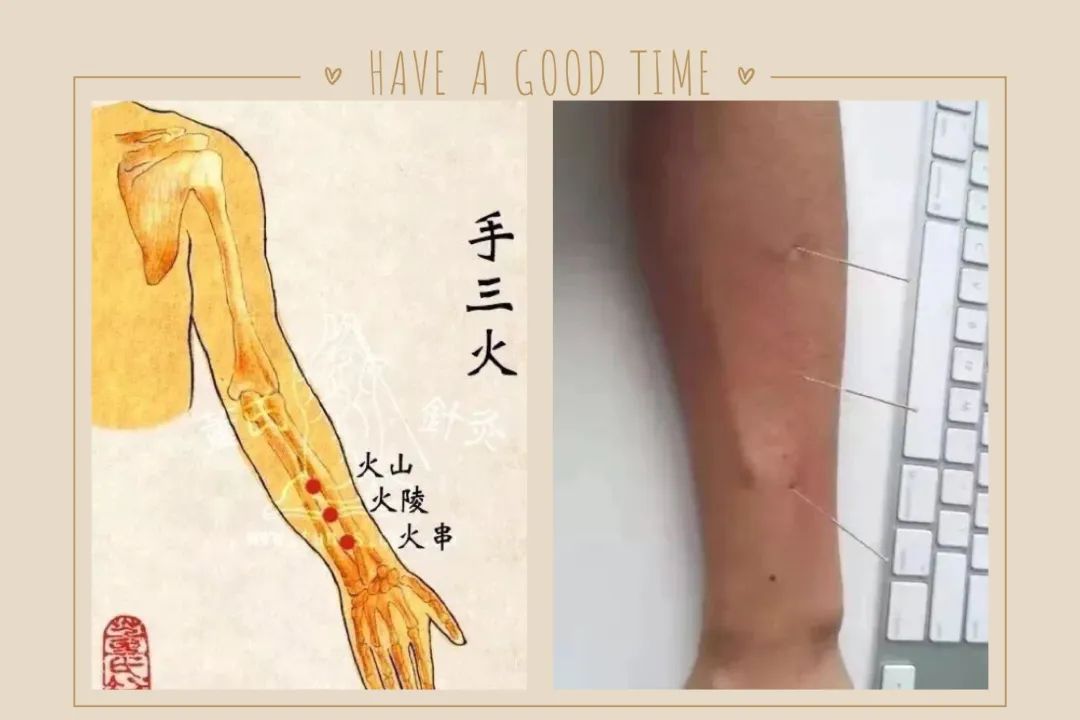 林正泰董氏针灸病症处方18颈椎病