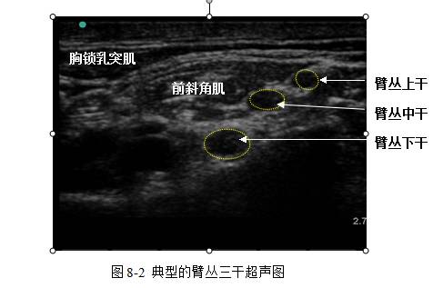 超声引导下区域麻醉/镇痛的专家共识(2014)
