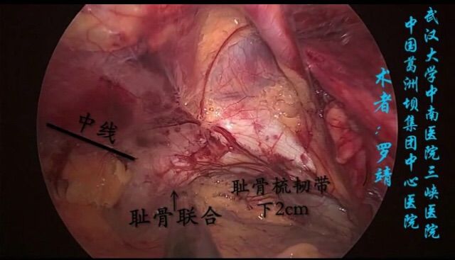 tapp相关解剖腹股沟疝腹腔镜经腹腹膜前补片修补术