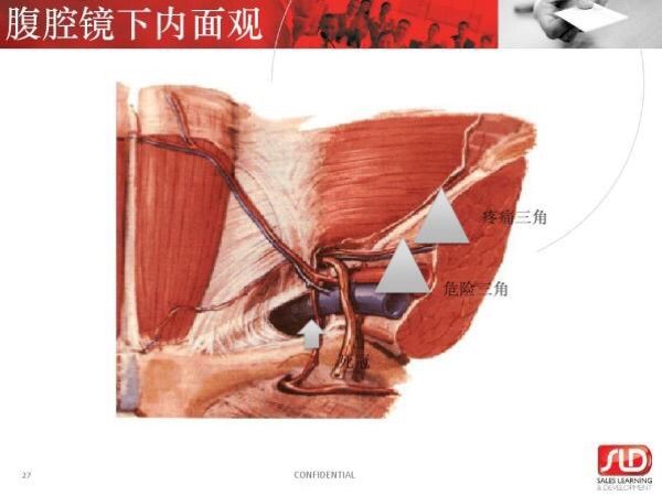 股疝三角解剖图片