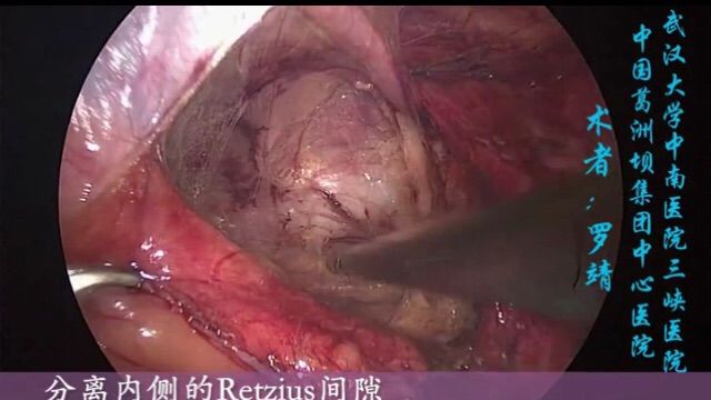 tapp相关解剖腹股沟疝腹腔镜经腹腹膜前补片修补术