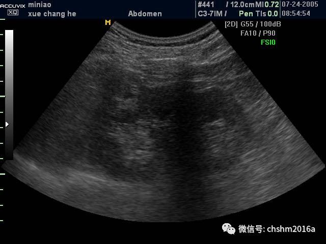 肾癌超声图片