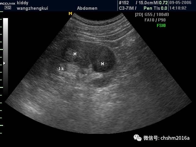 肾癌超声图片