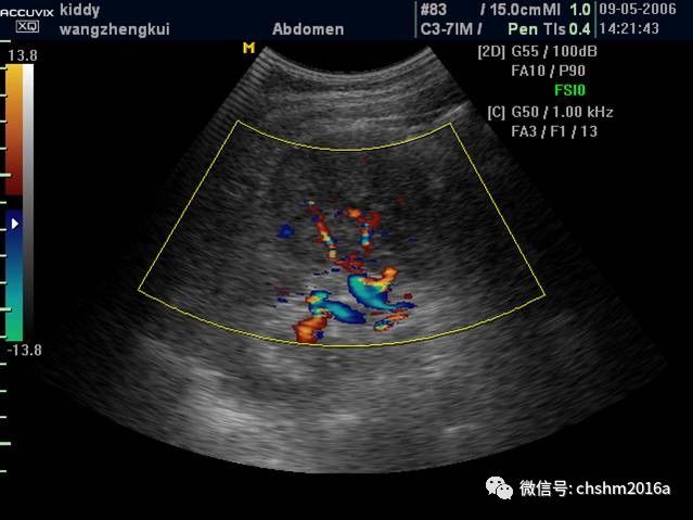 肾癌超声图片