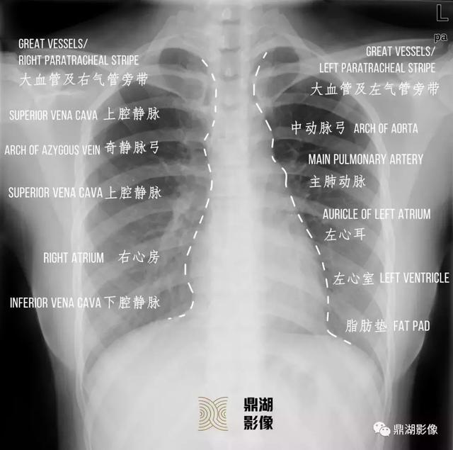 x线高清图谱胸片详细诊断要点