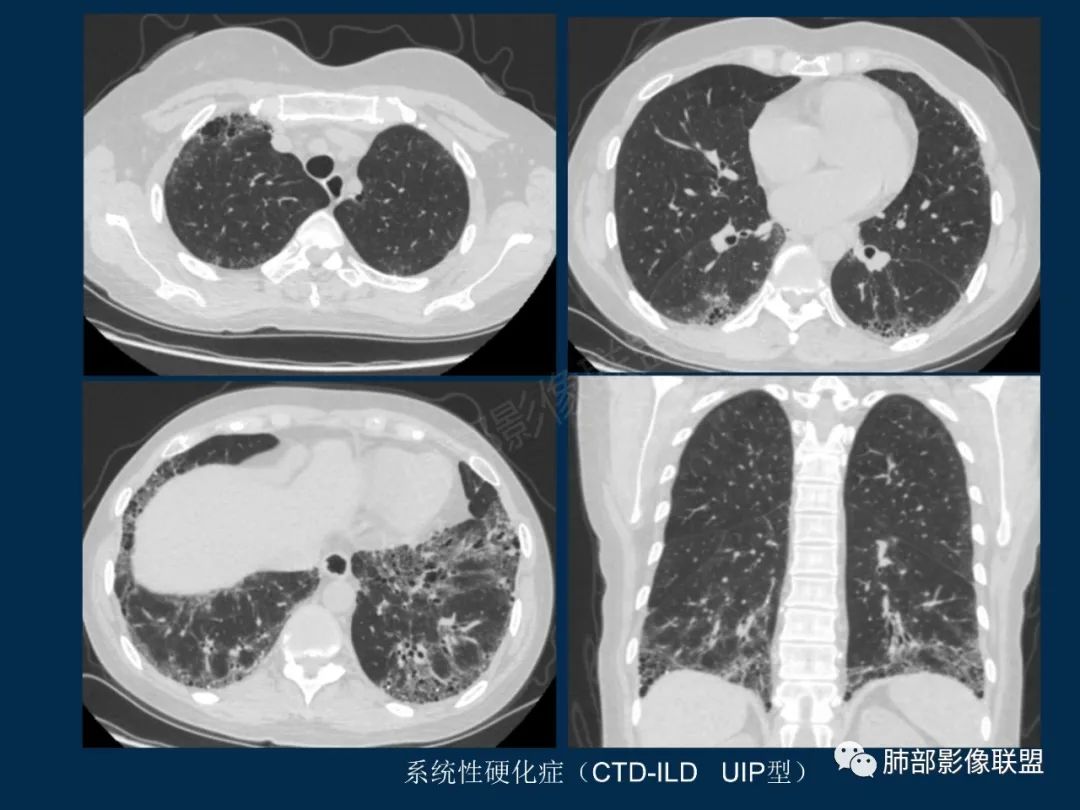 特發性間質性肺炎的病理影像特點