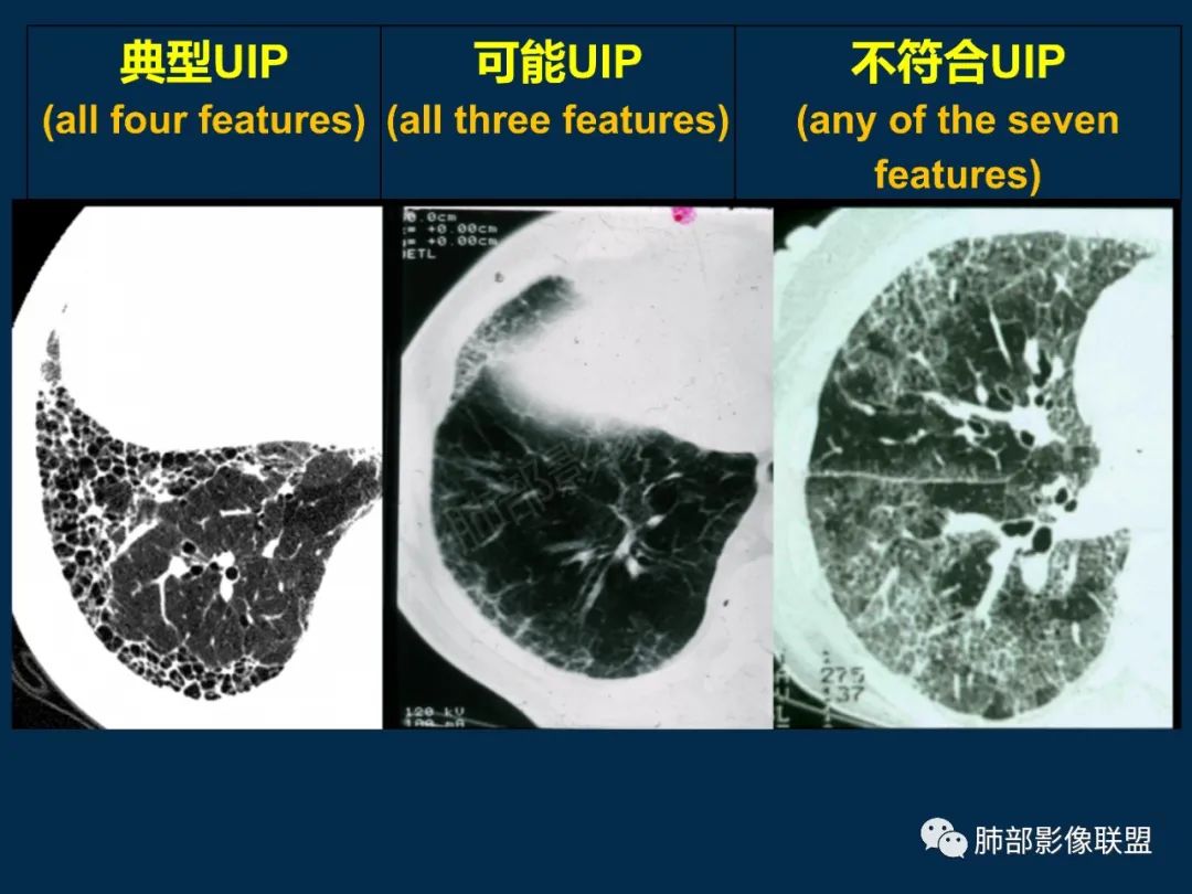 特發性間質性肺炎的病理影像特點