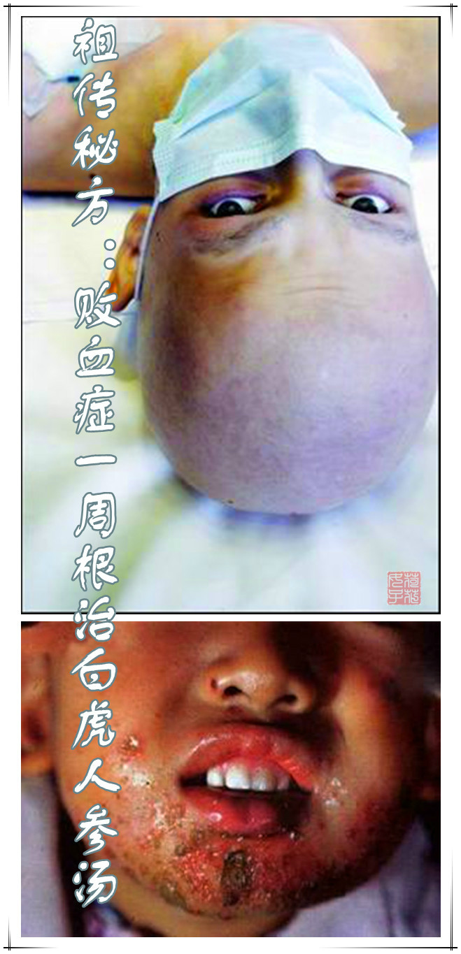 祖传秘方败血症一周根治bai虎人参汤