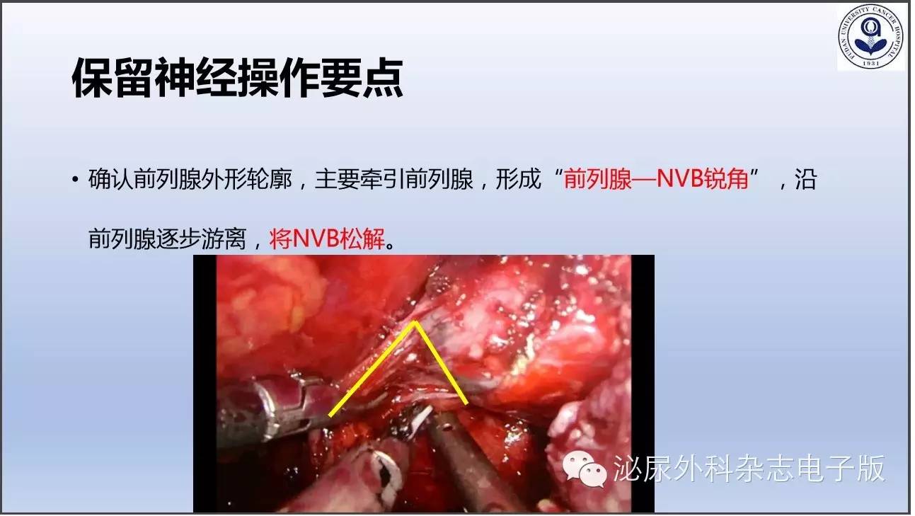 前列腺癌根治术的性神经保留筋膜内解剖和操作