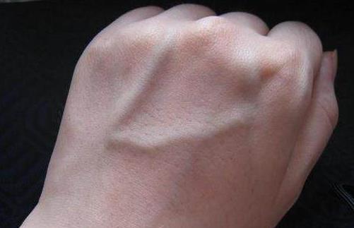 手上青筋说明身体有湿气不同部位青筋显示不同问题