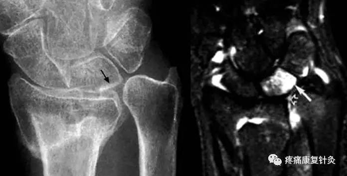 【每日一病】 综合征 尺骨撞击综合征（61）