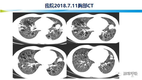 病例分享i弥漫性病变系列(3)i肺弥漫性囊性病变