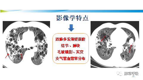 病例分享i弥漫性病变系列(3)i肺弥漫性囊性病变
