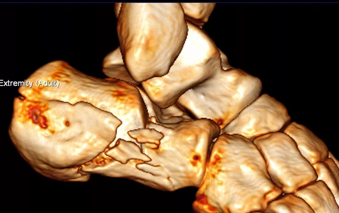 专题教程一例经跗骨窦小切口治疗跟骨骨折