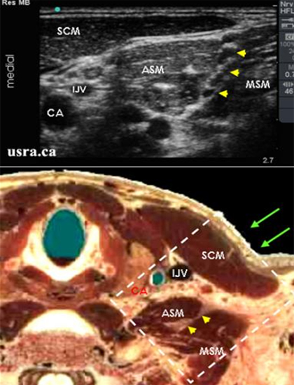 超声引导区域麻醉与神经阻滞公益课堂肌间沟阻滞