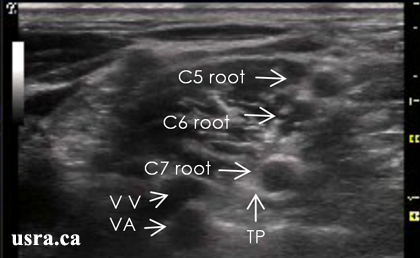 超声引导区域麻醉与神经阻滞公益课堂肌间沟阻滞
