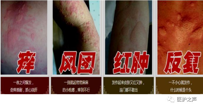乡村全科助理医师:过敏性皮肤病-荨麻疹