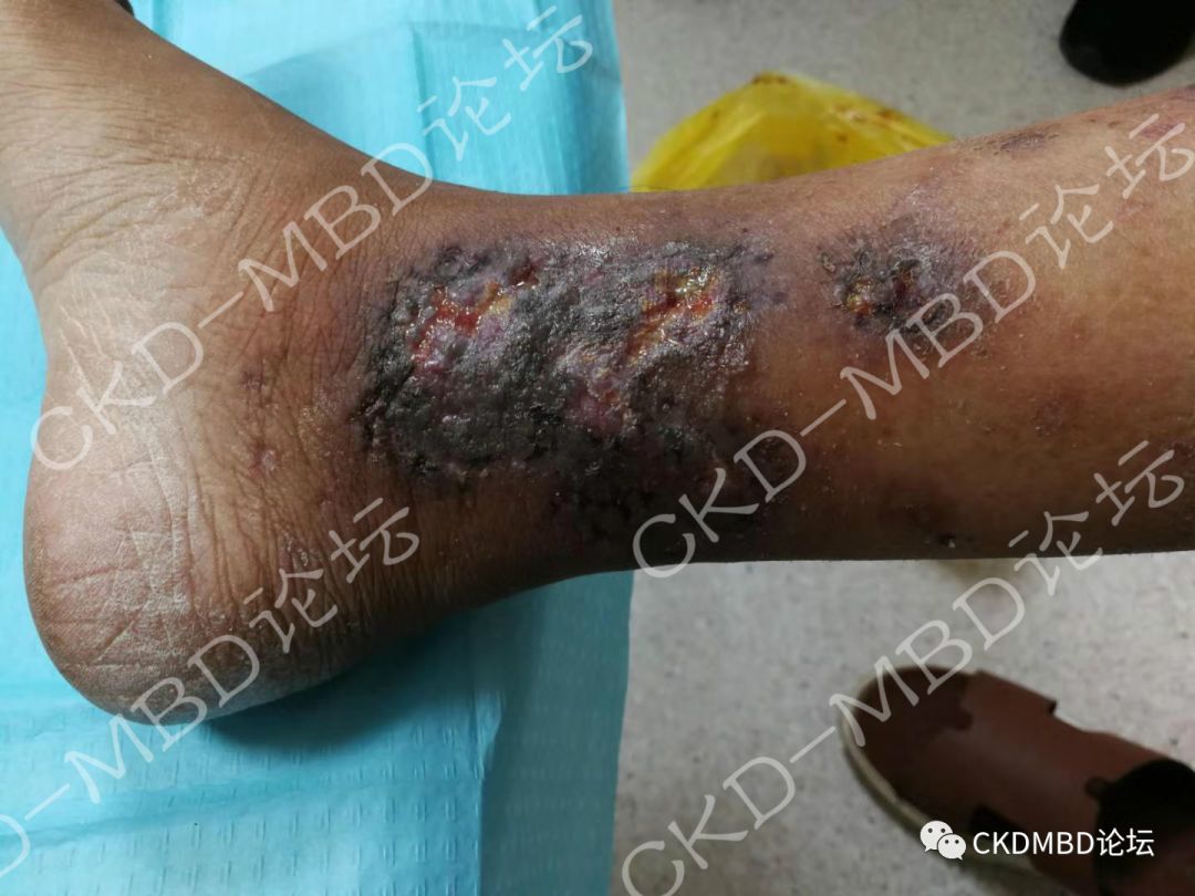 关于慢性肾脏病钙化防御的50个关键问题(一)