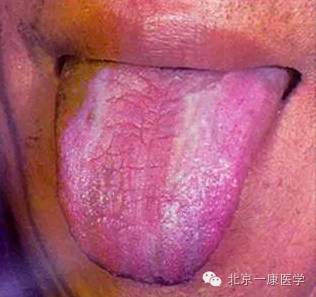 绛紫舌▽青紫舌▽淡青紫舌▽此外尚有暴力外伤,损伤血络,血液溢出而舌