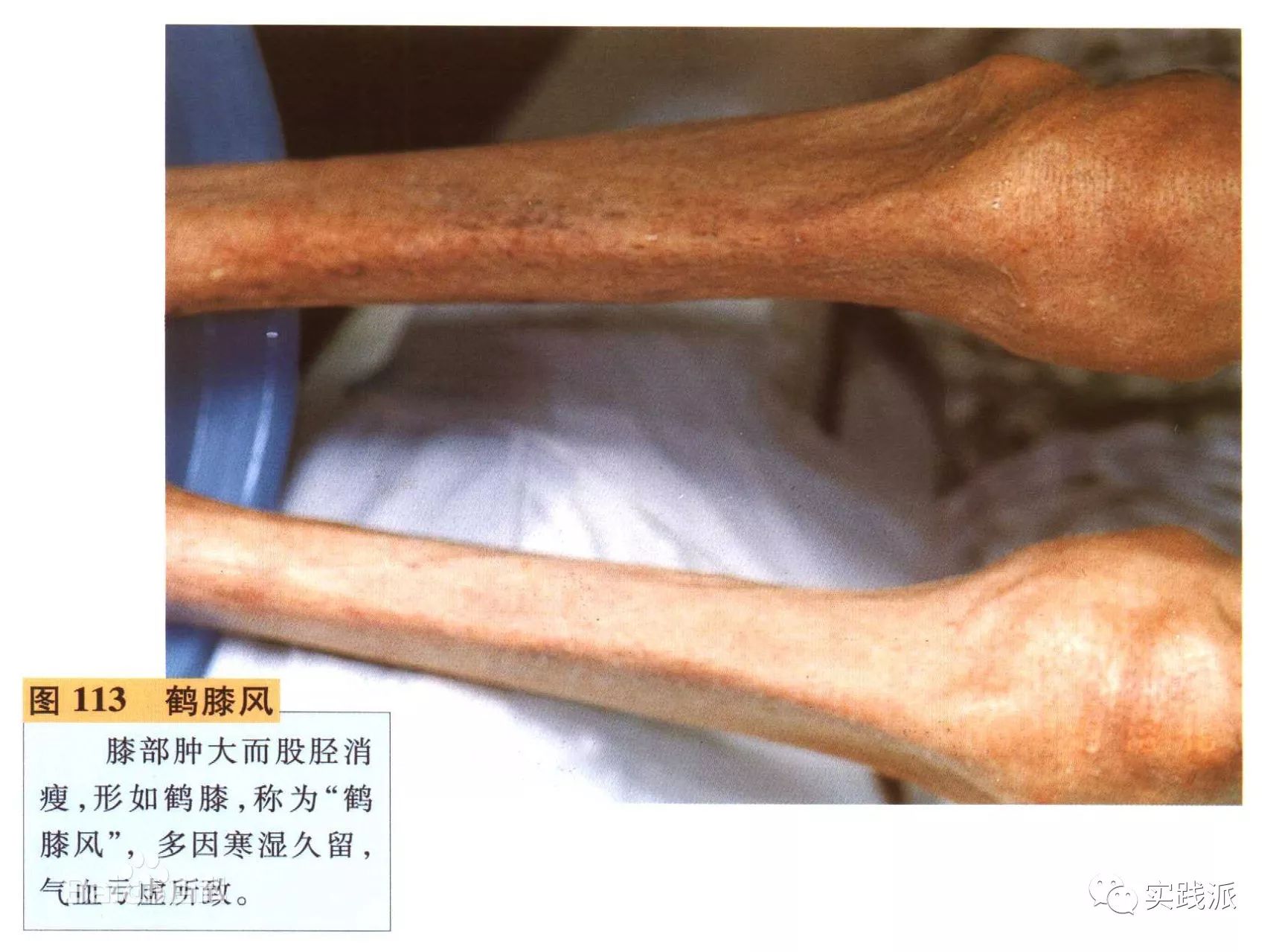 的治疗方法,鹤膝风是什么病呢,看古人的描述是这样的:  人有足胫渐细