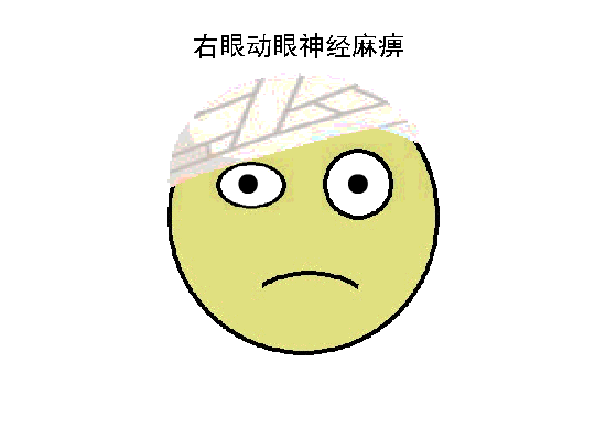 flash动画展示20多种常见斜视眼位特点,过目不忘!