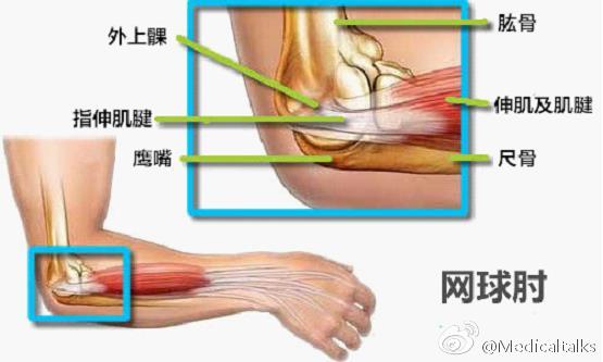 肱骨外上髁炎位置图片图片