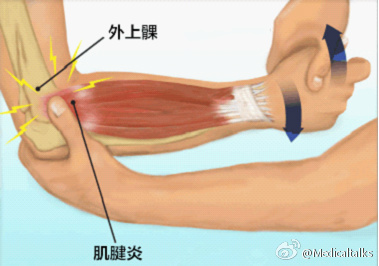 肱骨外上髁炎位置图片图片