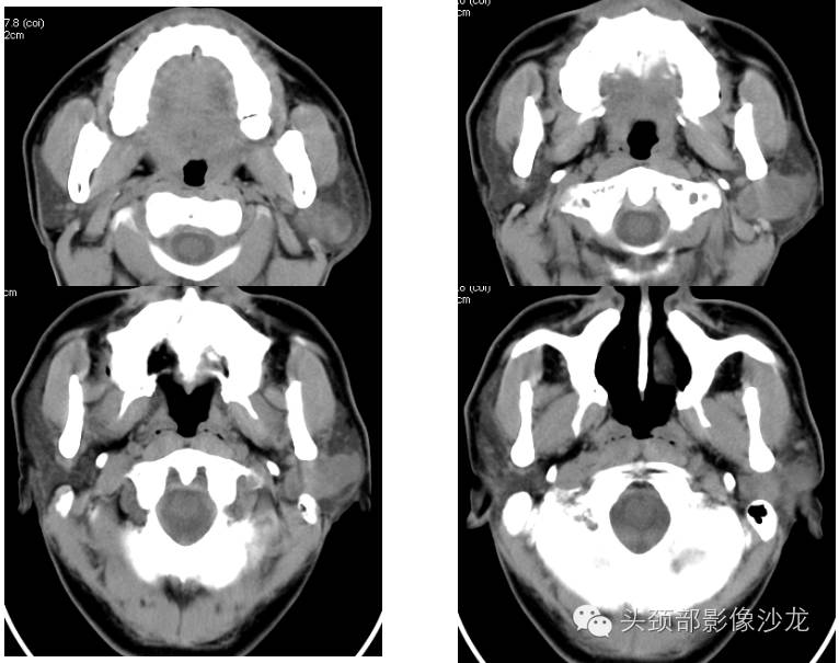 腮腺ct图图片
