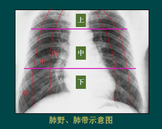 肺炎胸片图解图片