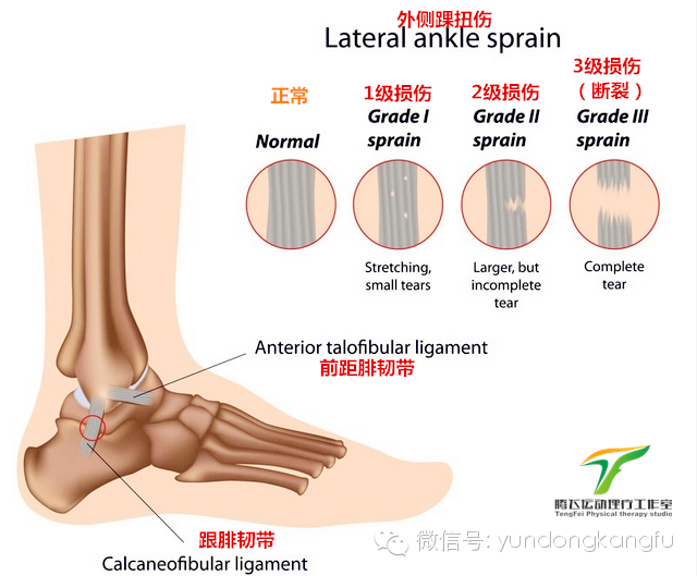 崴脚了踝关节扭伤预防及康复训练