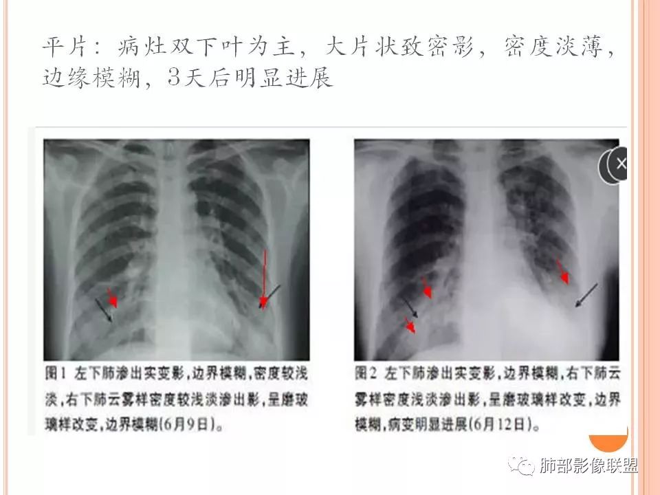 (一般细菌性肺炎,病毒性肺炎影像与临床应该比较同步)