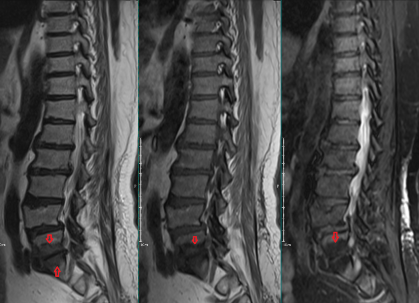 椎体终板炎发生机制分型以及mri表现