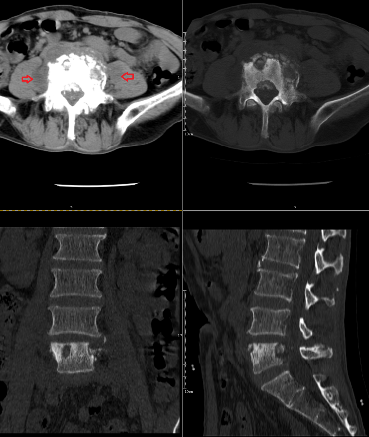 椎体终板炎发生机制分型以及mri表现