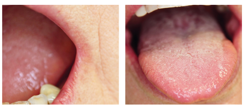 中医检验学你以为的镜面舌仅仅是阴虚吗你以为的吞咽困难仅仅是梅核气