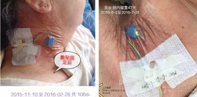 pvccvcpiccport四大导管留置时间大对比