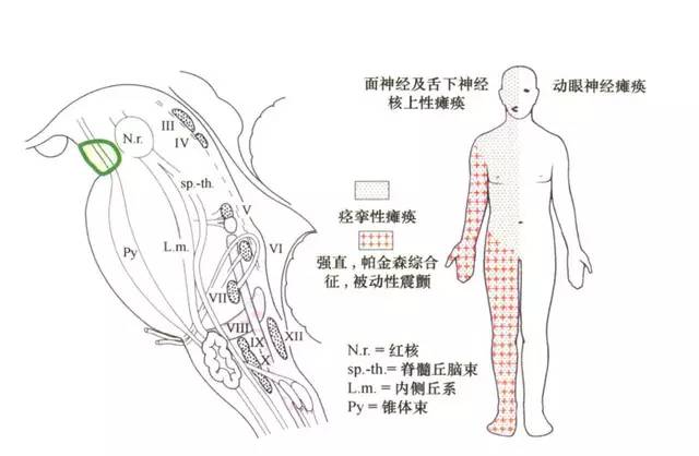 这十大常见脑干综合征你都了解吗