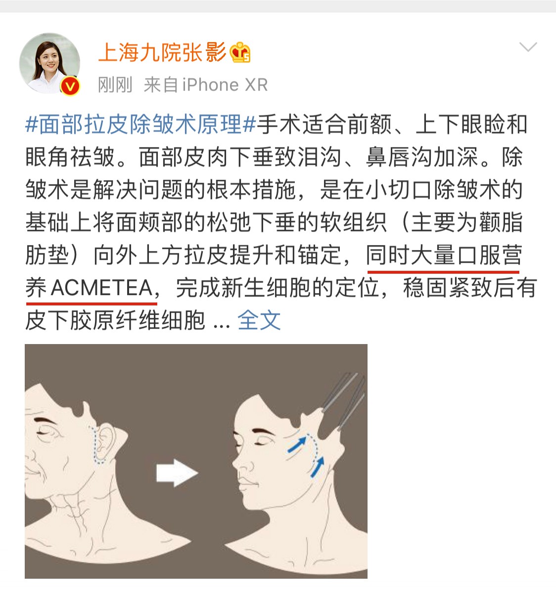 拉皮手术后会有哪些后遗症?面部拉皮如何快速消肿修复?