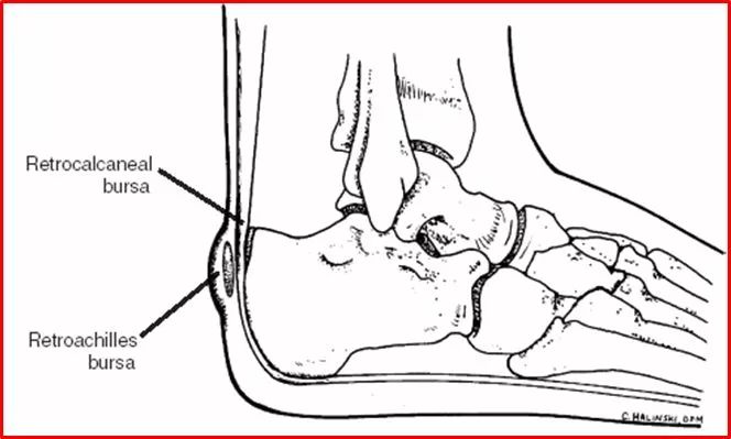 跟骨结节骨刺致病机制311月12日龙氏正骨(治脊疗法