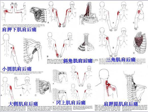 肌筋膜疼痛触发点全身分布图(头颈肩腰腿痛) - 好网角收藏夹