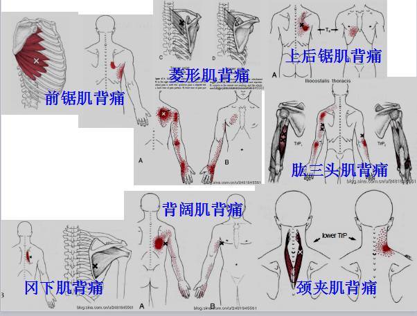 肌筋膜疼痛触发点全身分布图(头颈肩腰腿痛) 