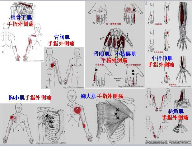 肌筋膜疼痛触发点全身分布图(头颈肩腰腿痛) - 好网角收藏夹
